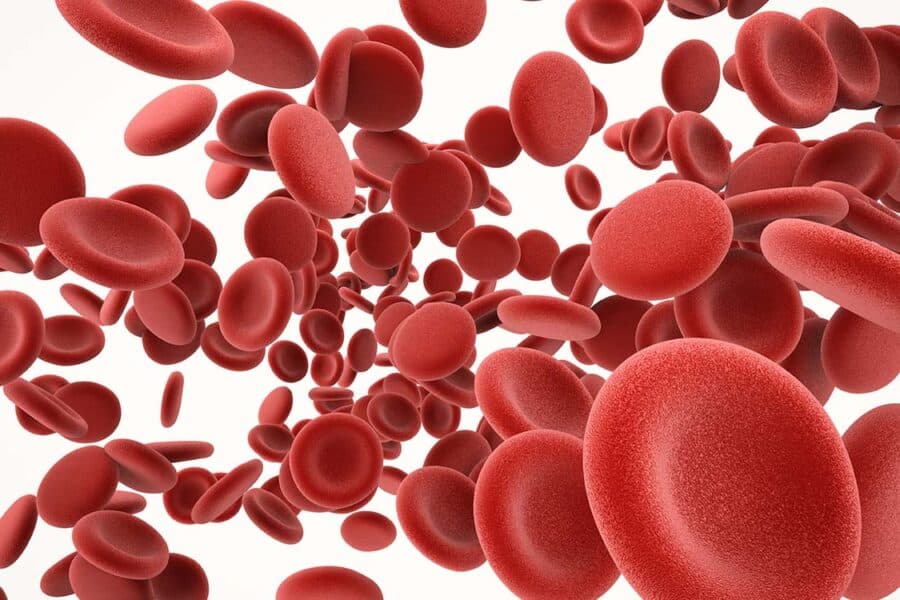 Iron Deficiency Anemia Image