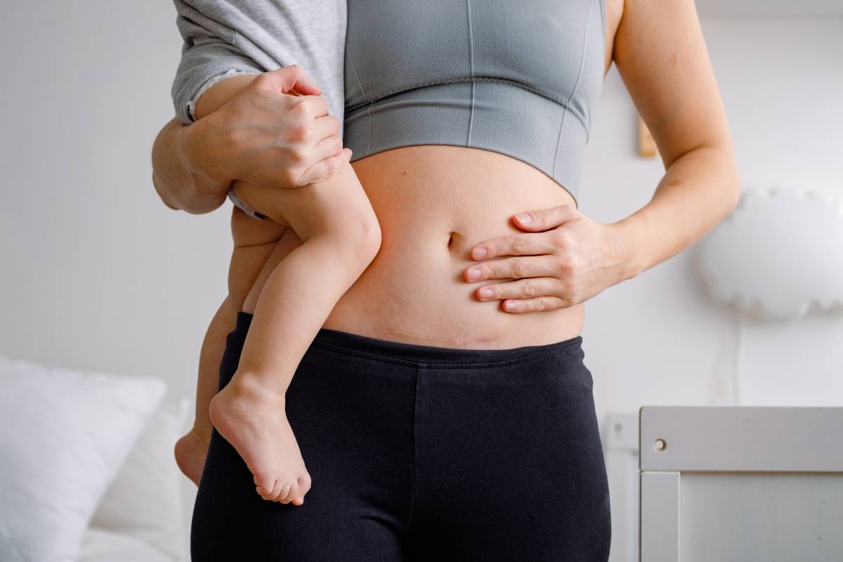 C-Section Recovery: Tips for Healing and Caring for Your Scar